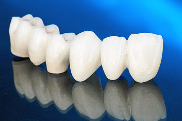 Vollkeramische Kronen