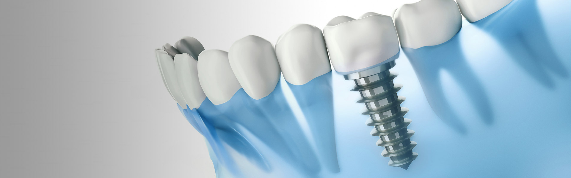 Ersatz für fehlende Zähne - ästhetisch und belastbar