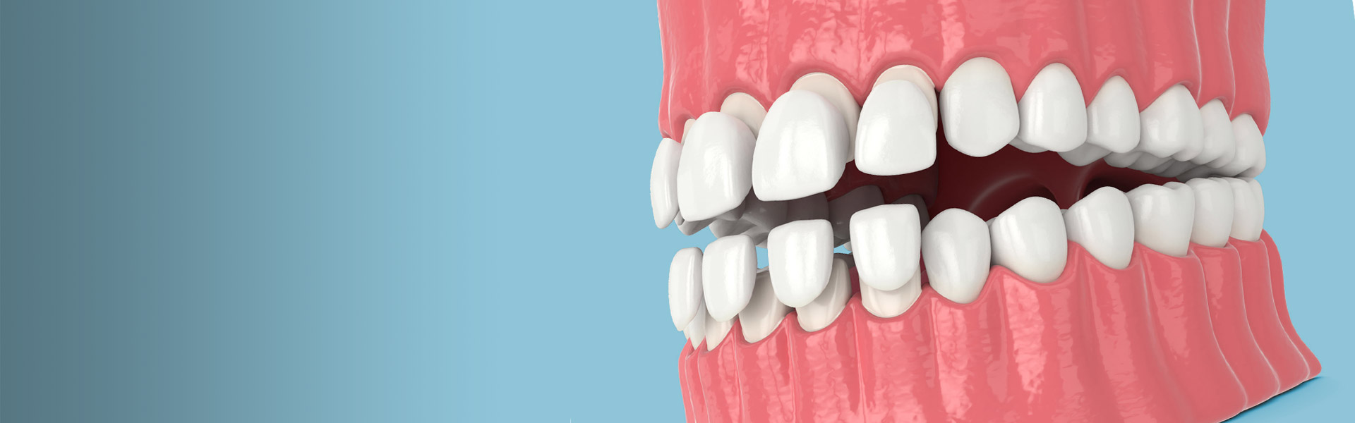 Hauchdünne Verblendschalen aus lichtdurchlässiger Keramik